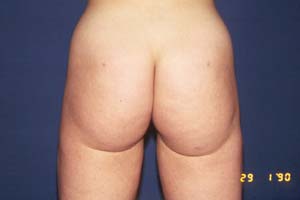 LIPOSUCTION - AFTER